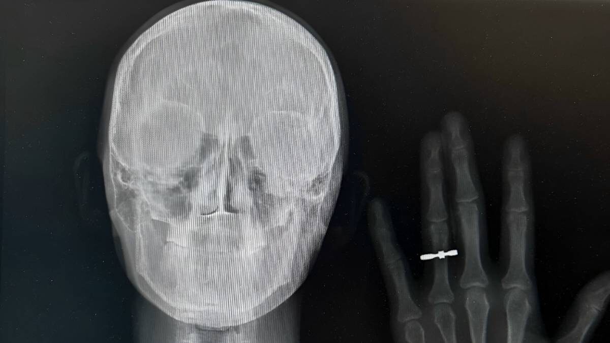    Рентгеновский снимок молодоженов из Новосибирска Кристины Шрайнер и Станислава Ефремова / Фото: Предоставила Кристина Шрайнер