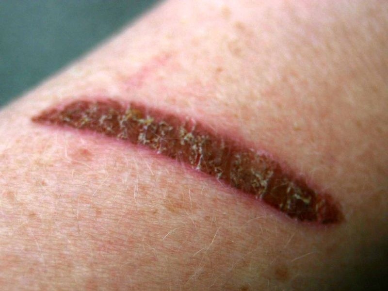     Ожог руки   
(cc) Jo & Paul