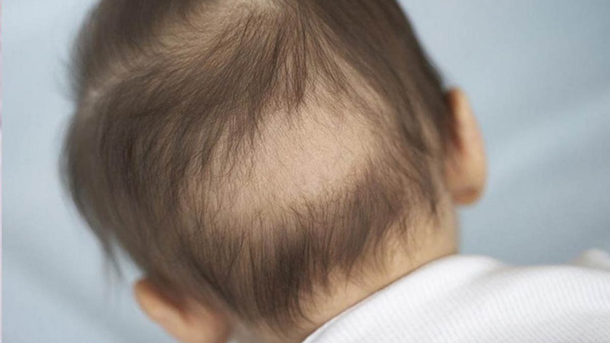 признаки рахита