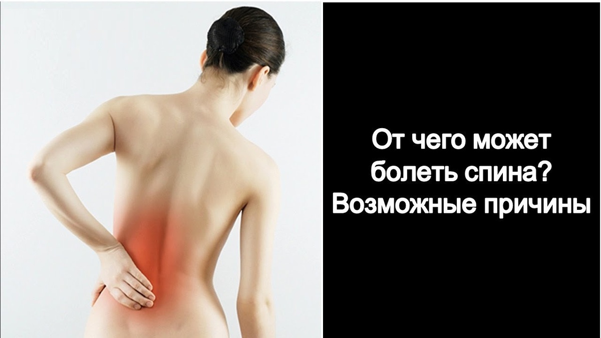 Почему у вас болит спина — и дело не в грыже