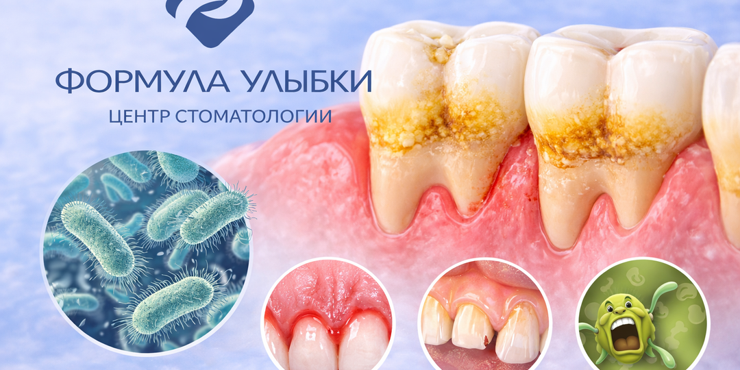 Что будет, если не лечить кариес – этапы разрушения зуба (без запугивания)