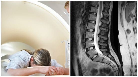 5 реальных причин боли в пояснице при “чистом” МРТ
