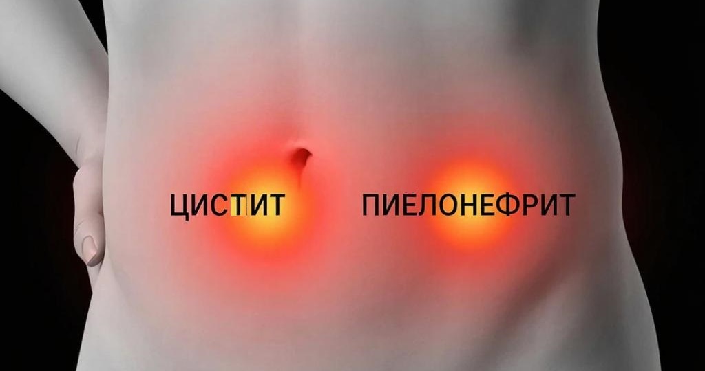 Внизу болит по-разному: как по одному симптому отличить цистит от пиелонефрита