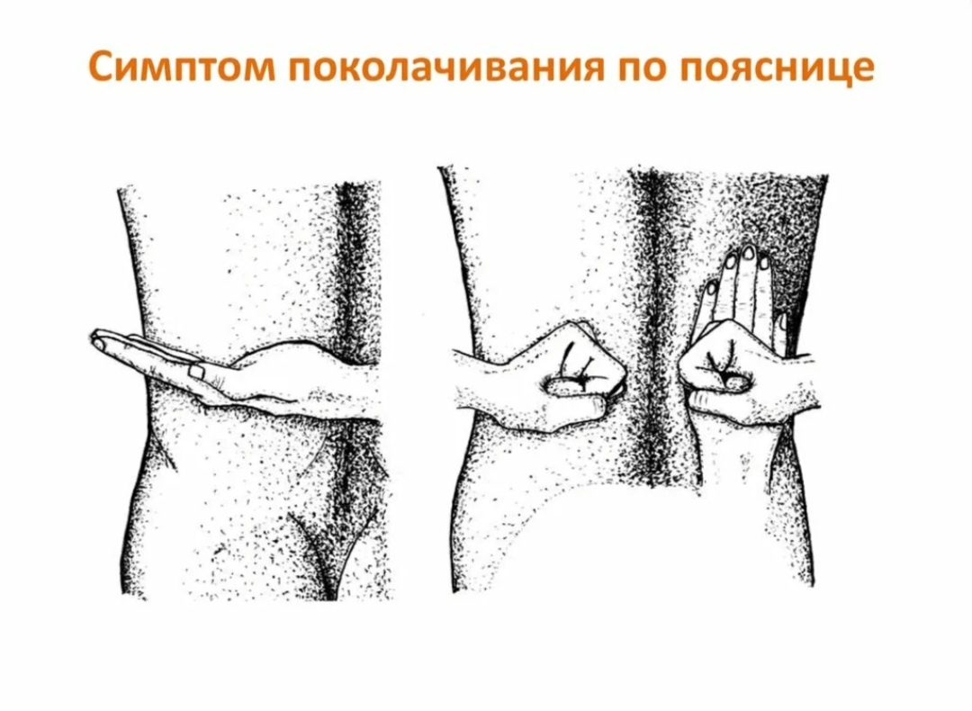 симптом Пастернацкого