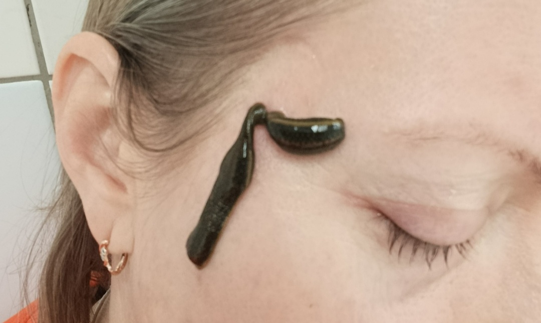 Гирудотерапия в офтальмологии. Надеюсь не шок-контент. Вполне милые пиявочки.