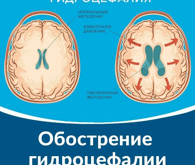 ВЕСЕННЕЕ ОБОСТРЕНИЕ ГИДРОЦЕФАЛИИ ❓️