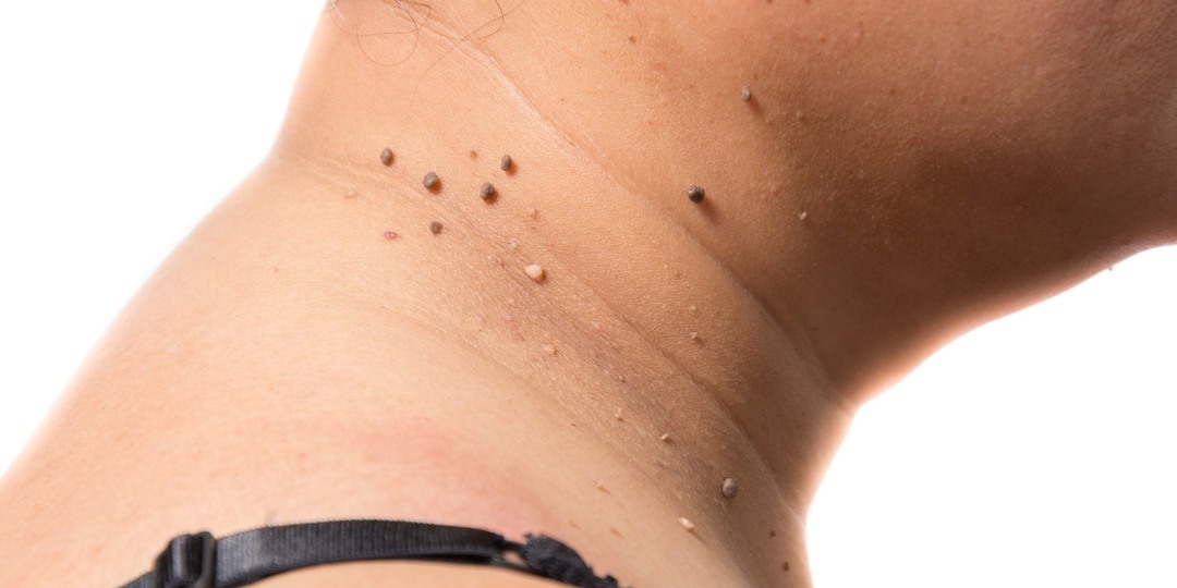 Этот сигнал на коже часто пропускают годами