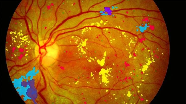     Retina.AI выделяет проблемные места на снимке глазного дна цветом, что облегчает «прочтение» патологий