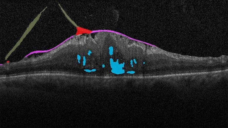    : Скан ОКТ сетчатки позволяет видеть ее слои