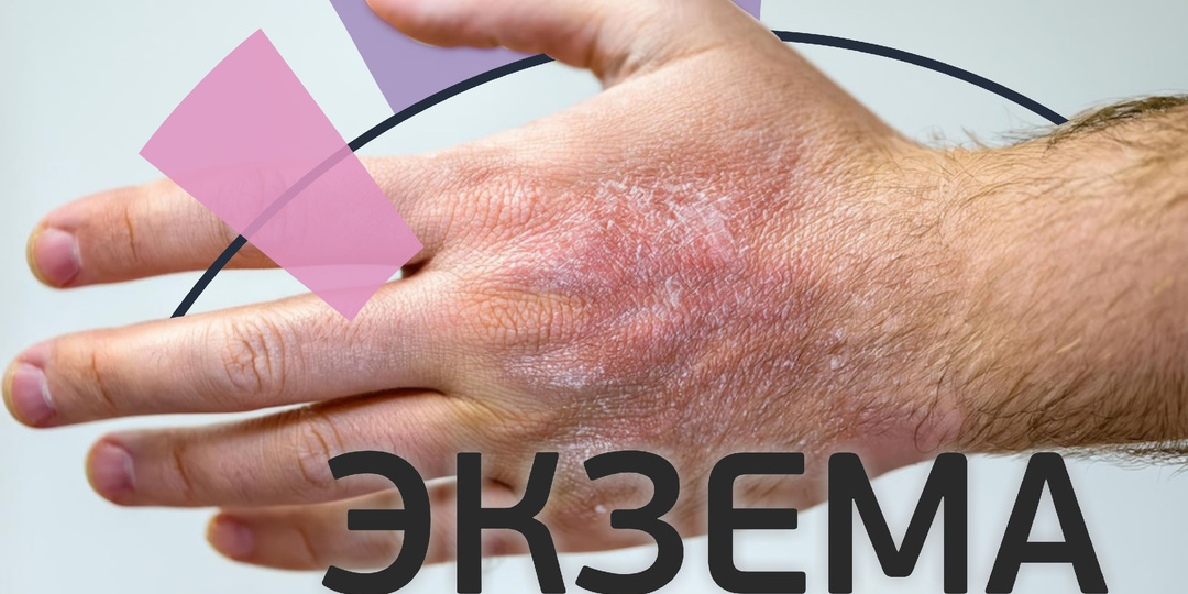 Экзема. Симптомы, причины и лечение.