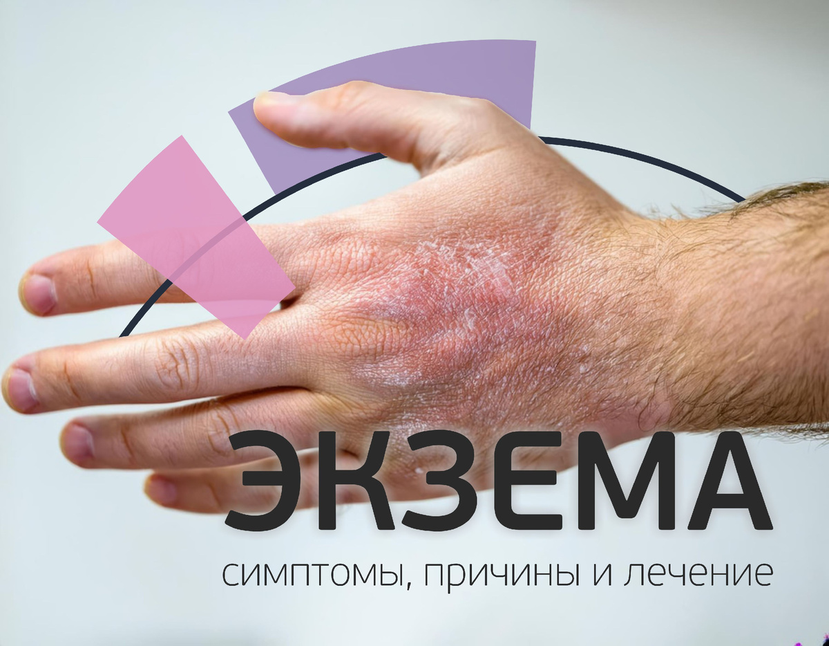 Экзема: симптомы, причины и лечение - как выглядит экзема на руках и теле