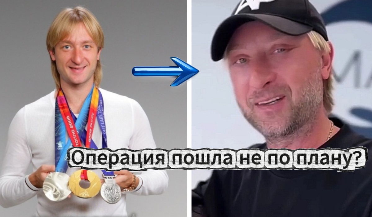 Евгений Плющенко до и после пластической операции!