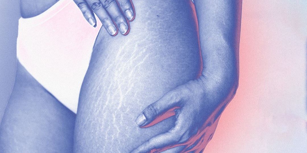 Растяжки, шрамы, воспаления — принять нельзя отвергнуть: где поставить запятую в отношениях со своей кожей