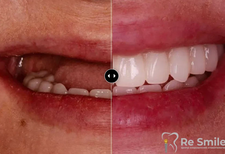 Пациентка обратилась в клинику ReSmile с жалобами на отсутствие зубов на верхней челюсти.

Пациентке была проведена полная диагностика, после чего восстановлен зубной ряд по методу All on 4. Жевательная функция полностью восстановлена за 3 дня.