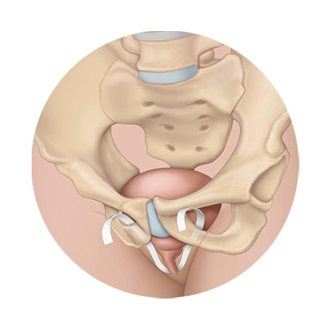 ЛФК при опущении органов малого таза (пролапс): как подобрать безопасную нагрузку