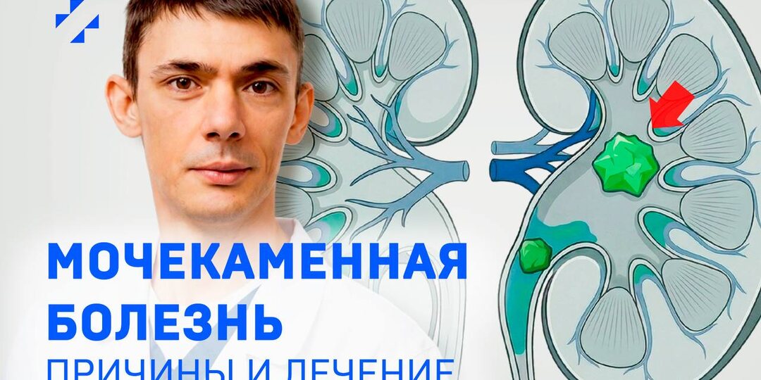 🎬 Ответы на вопросы о мочекаменной болезни