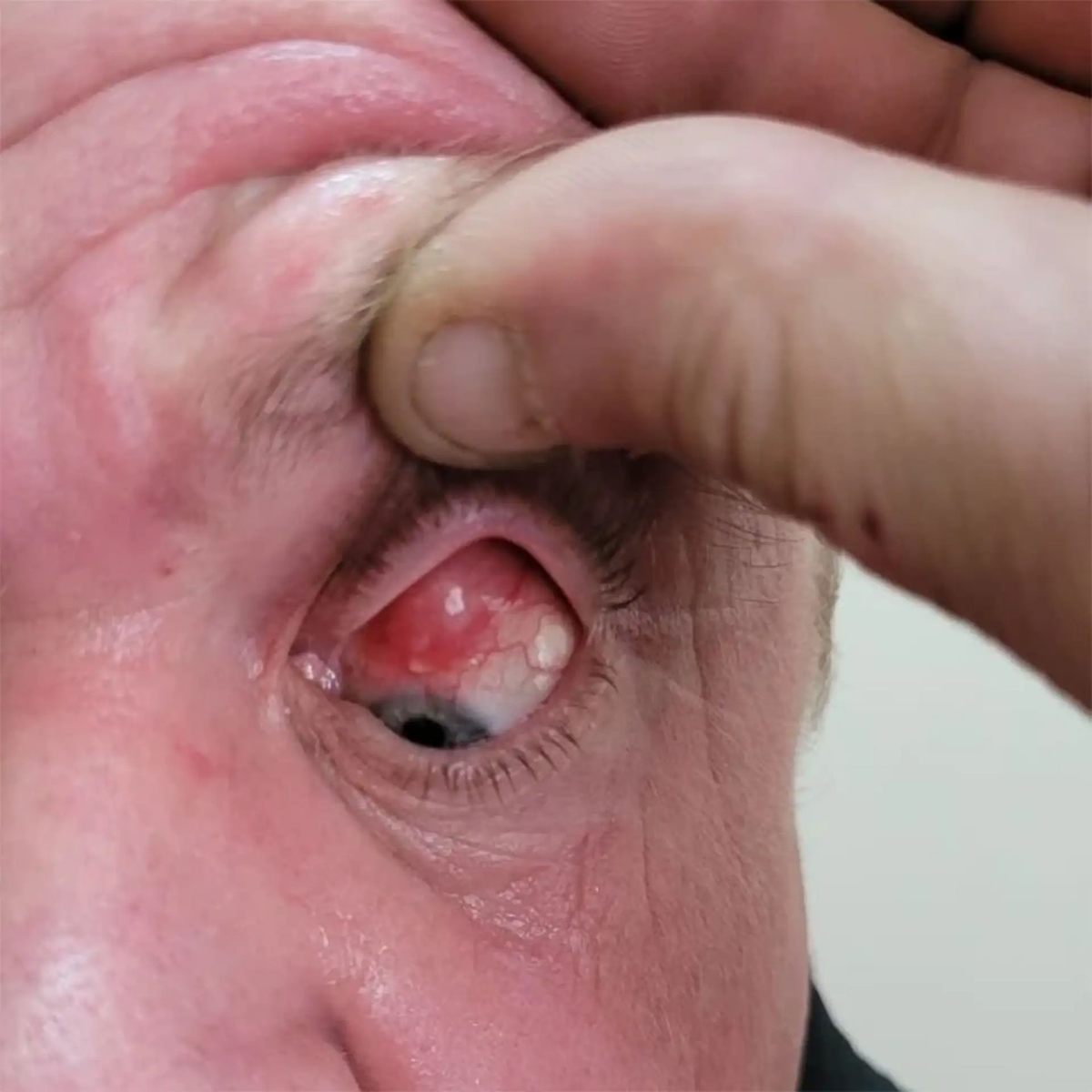 Инородное образование под верхним веком