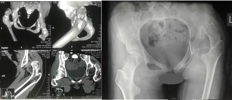 Рентгенография и КТ до операции (вывих левого бедра, разрушение головки бедра с полной потерей сферичности)