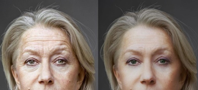 Уменьшение морщин