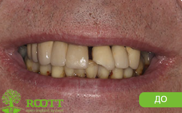 Пациент обратился с жалобами на сильную подвижность зубов