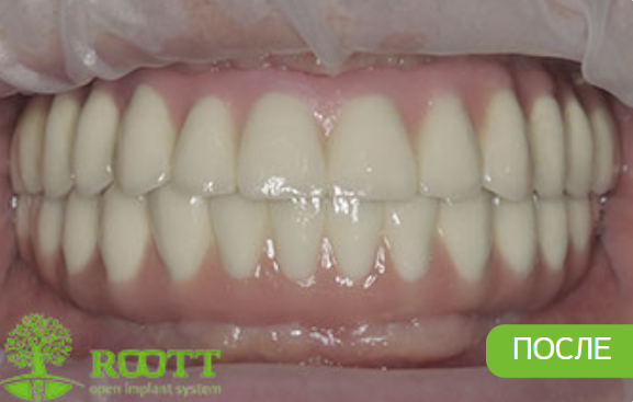 На верхней челюсти была проведена одномоментная имплантация на 8 имплантах мульти юнит с одновременно проведенным синус лифтингом. На нижней челюсти проведена комплексная одномоментная имплантация. Были установлены металлокерамические протезы на винтовой фиксации. 