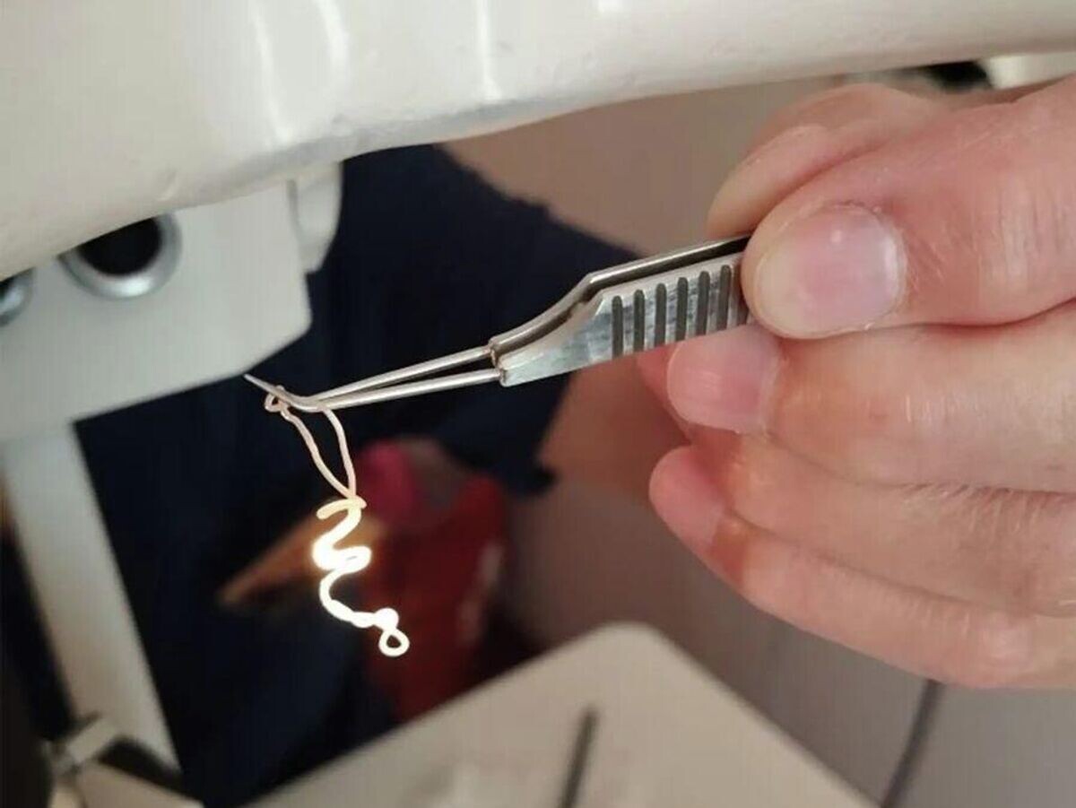    Офтальмологи центра Микрохирургии глаза имени академика Святослава Федорова в Чебоксарах извлекли из глаза пациента червя | © Фото : Министерство здравоохранения Чувашской Республики