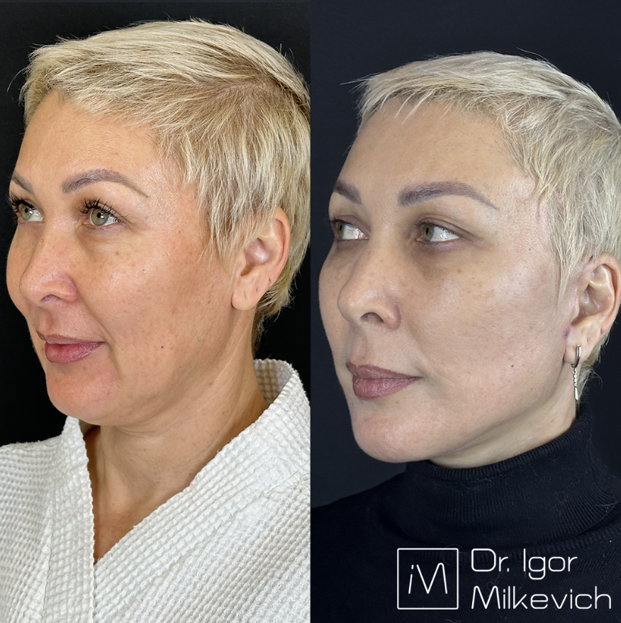 Месяц после операции