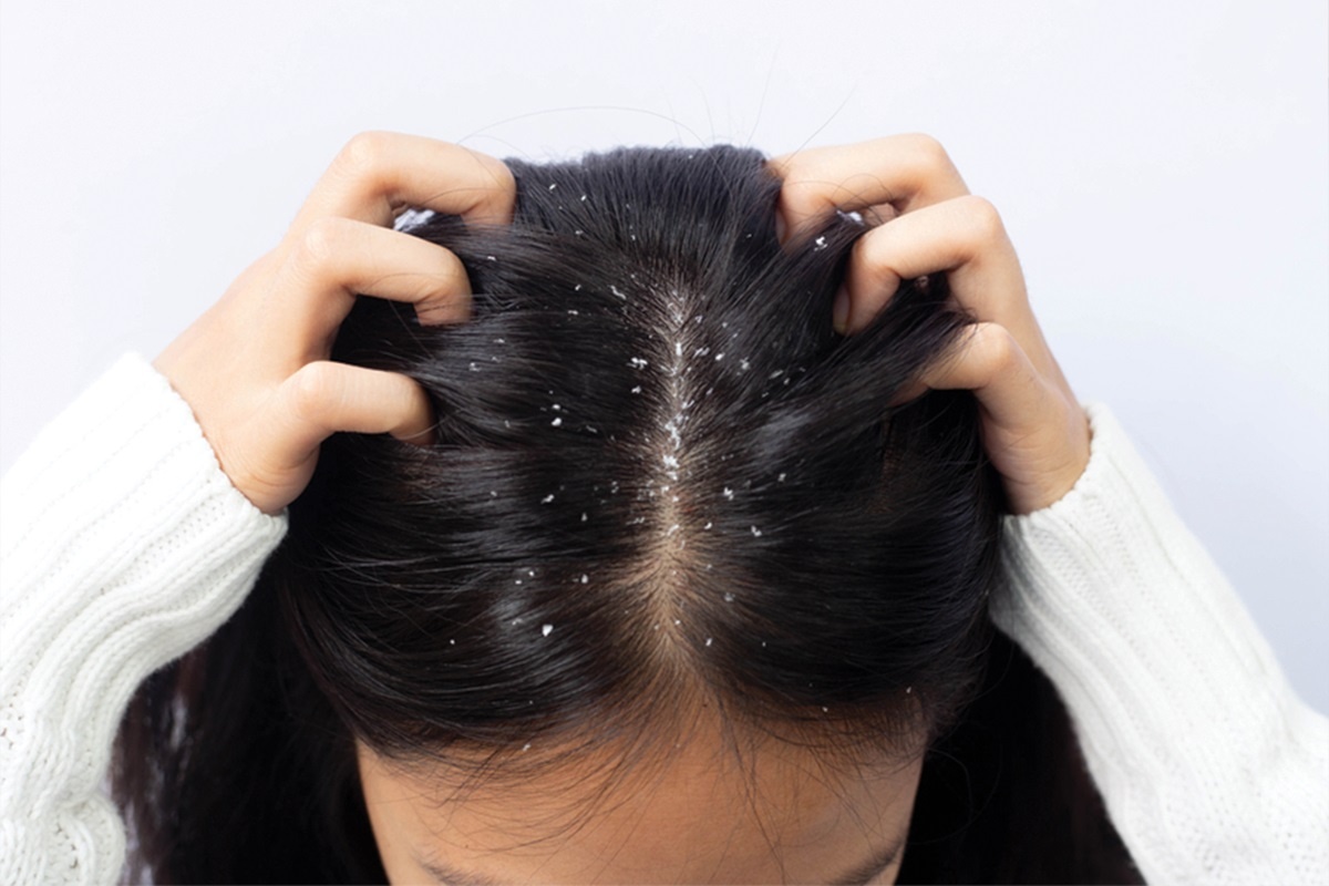 Фото с сайта: https://www.rosheta.com/en/13083/winter-dandruff-in-hair-and-the-best-shampoo-for-it
