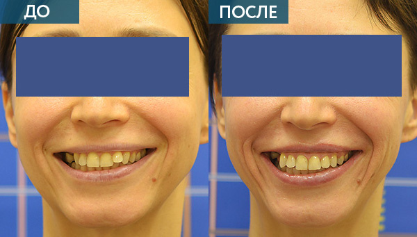 Зубы, исправление прикуса до и после лечения
