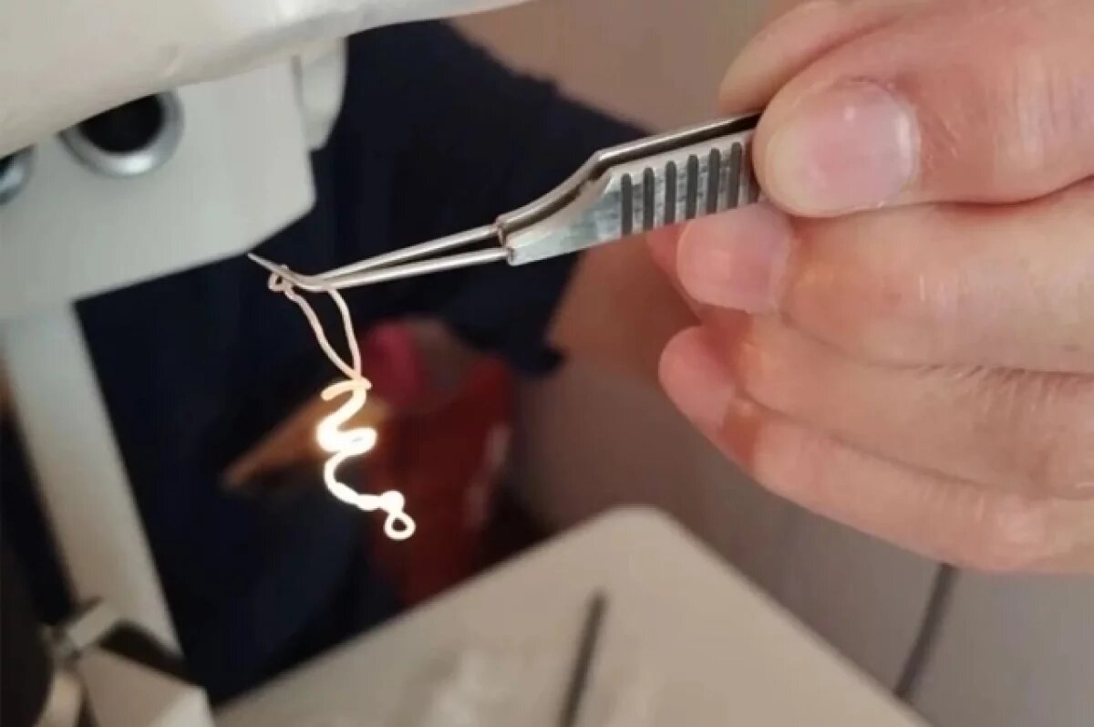    Чебоксарские врачи достали из глаза ульяновца 20-сантиметрового червя