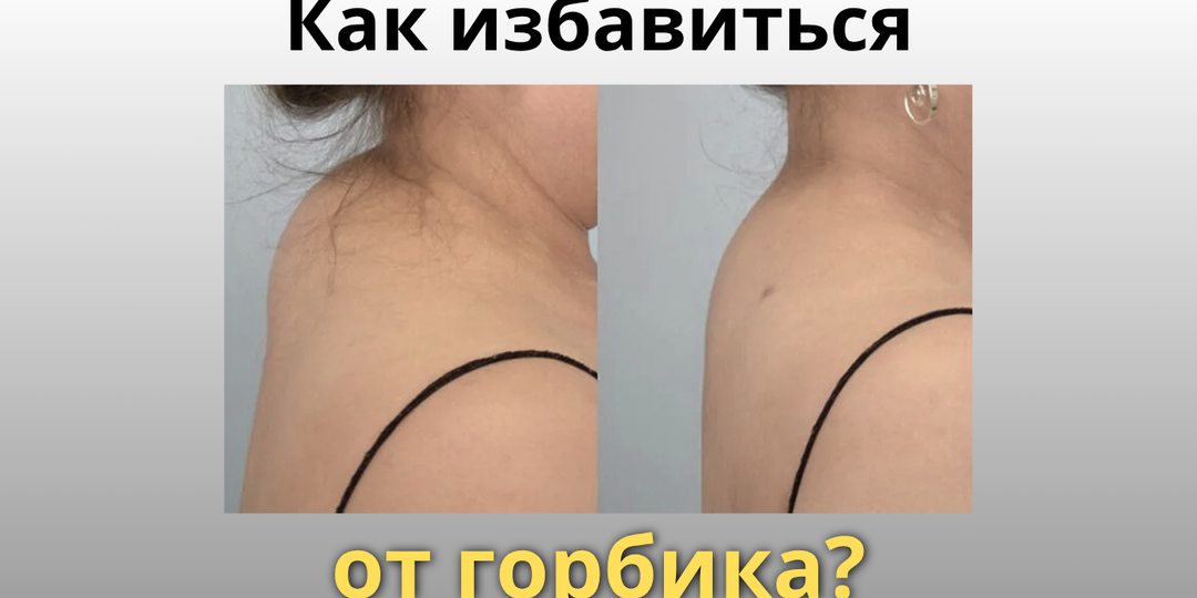 Почему появляется “горбик” на шее и можно ли от него избавиться
