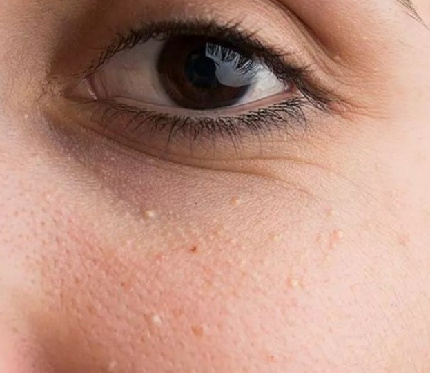 О жировиках: природа, уход и возможности домашней коррекции