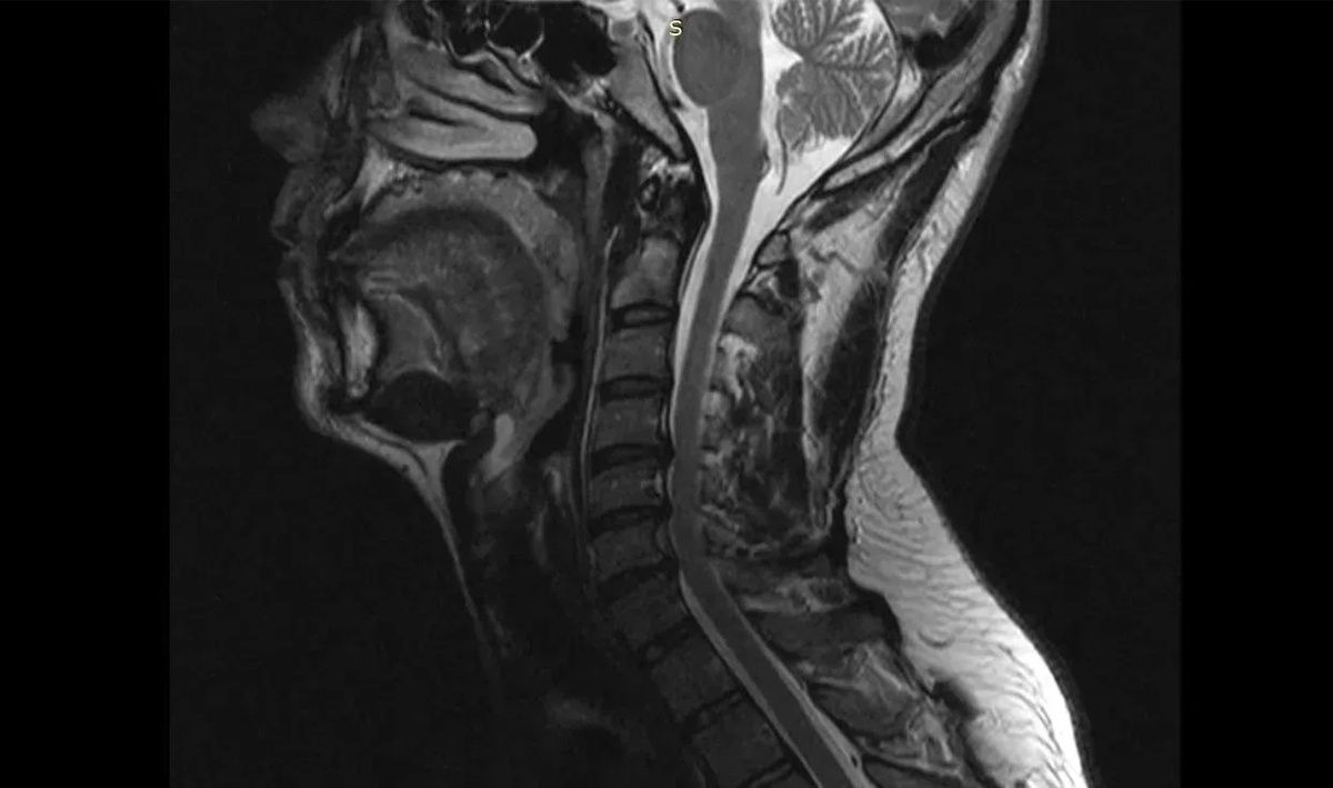     Шейный отдел позвоночника пациента до операции. Изображение: министерство здравоохранения Воронежской области