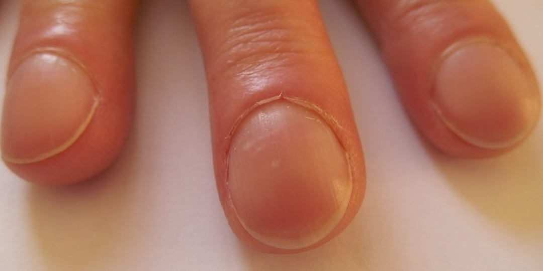 Ногти стали утолщаться — что это может означать
