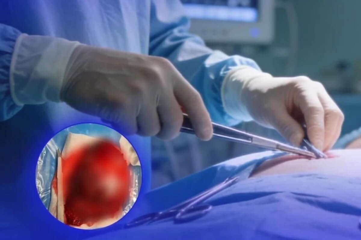    Во Владивостоке удалили 17-сантиметровую опухоль почки у 37-летней женщины