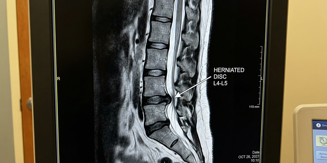 Грыжа позвоночника. Нужна ли операция, если таблетки не помогают? Ответ опытного нейрохирурга.