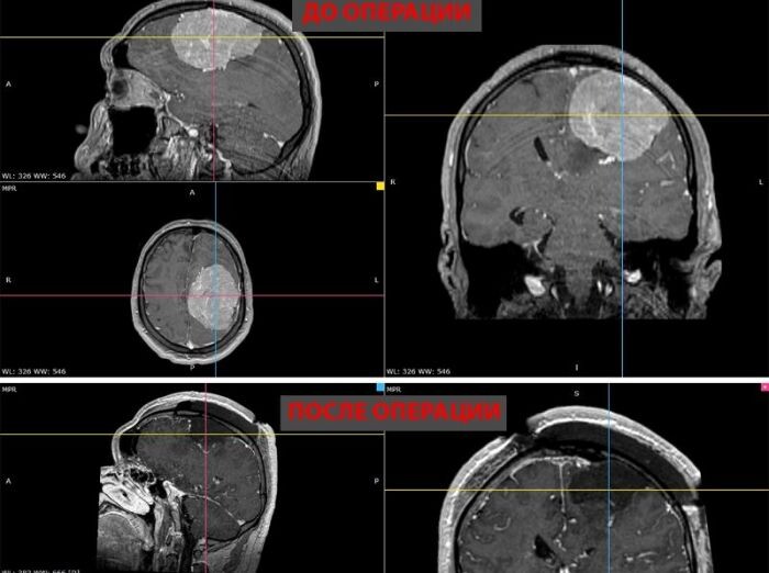 Гигантскую опухоль удалили молодому мужчине в центре Мешалкина