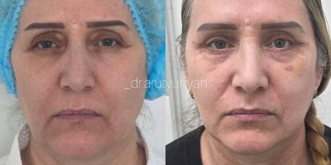 ✨ Что ждать через 14 дней после круговой блефаропластики