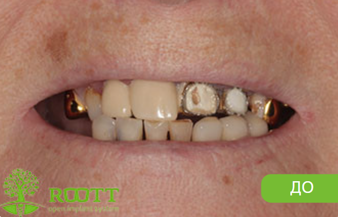 Пациентка обратилась с жалобами на отсутствие жевательных зубов и подвижность фронтальных зубов верхней челюсти. Была проведена комплексная одномоментная имплантация (установлены импланты одновременно с удалением подвижных зубов). 