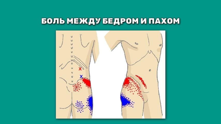 Почему болит между бедром и пахом?