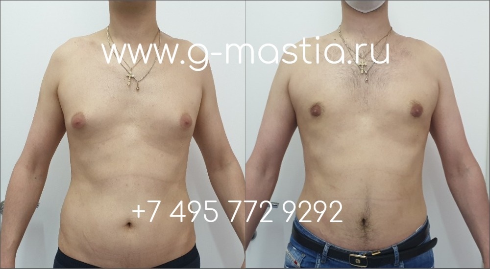 Результат удаления смешанной гинекомастии через 1 месяца