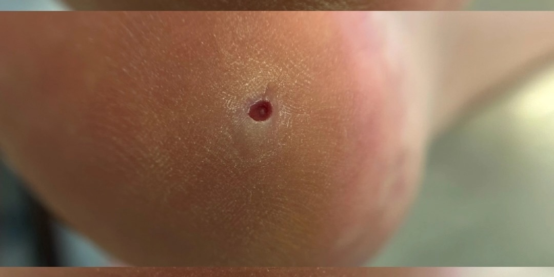 Заноза в пятке: почему “потерплю” — худшее решение, которое вы можете принять