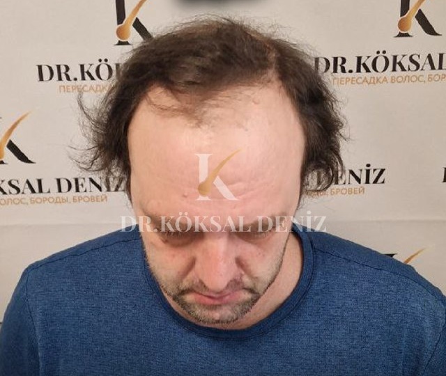 Результаты после пересадки волос (до/после)