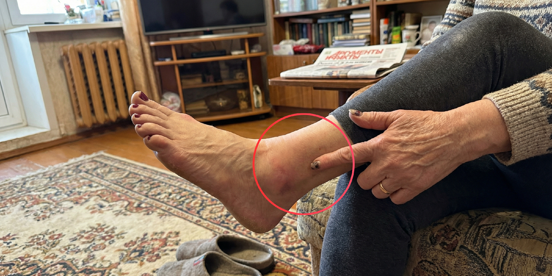 3 признака на стопе, которые выдают диабет раньше боли