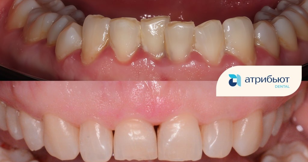 🦷 Глубже, чем просто налёт