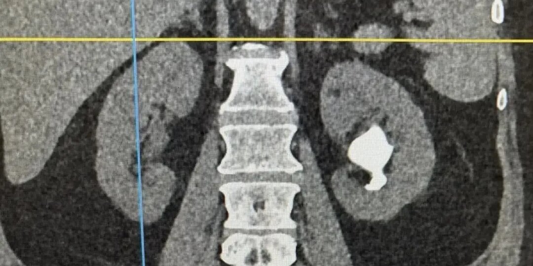 Врачи удалили крупный камень и сохранили почку женщине в Кемерове