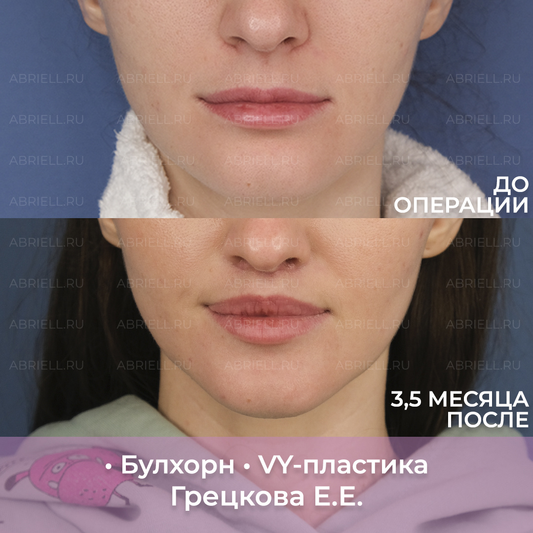 Увеличение губ / Булхорн и VY-пластика. Хейлопластика в Санкт-Петербурге. Результат пластики губ до и 3,5 месяца после операции / Грецкова Евгения Евгеньевна Пластический хирург клиники Абриелль  
