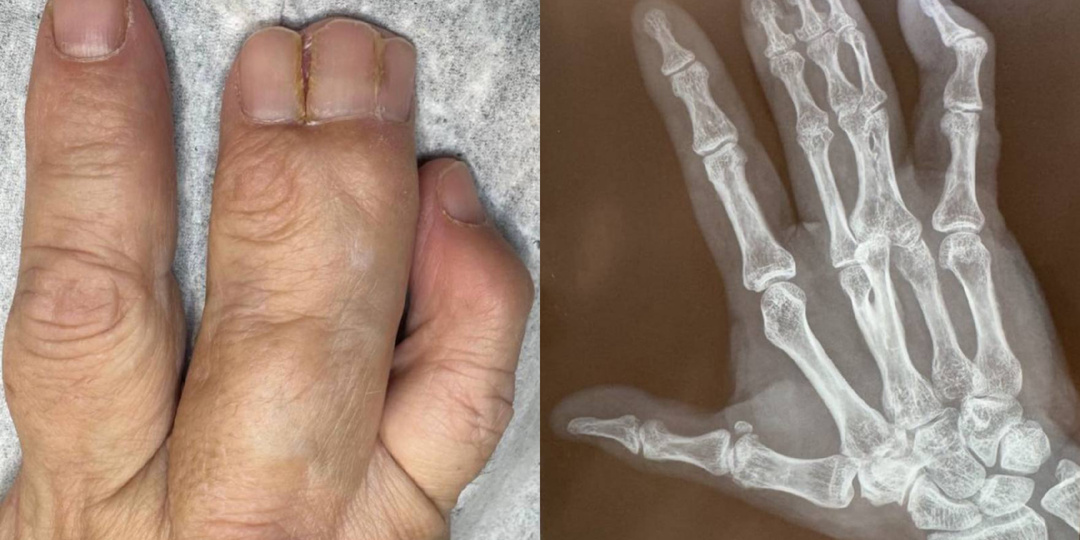 Сросшиеся пальцы: порок развития или приобретенное состояние?