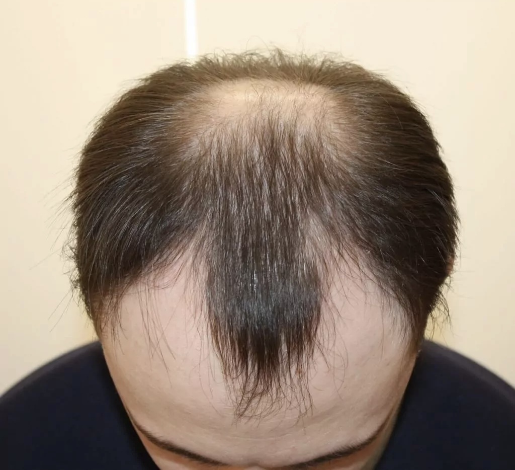 Изображение: Андрогенетическая алопеция