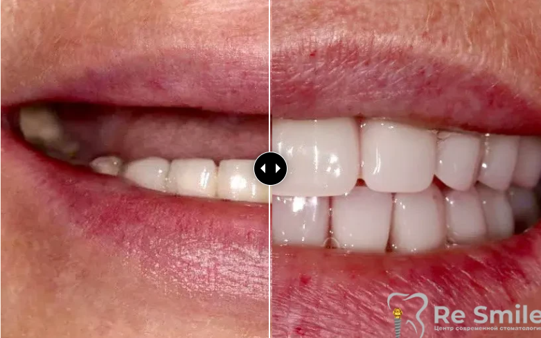 Пациентка обратилась с жалобами на полное отсутствие зубов на верхней челюсти и отсутствие жевательных зубов на нижней челюсти.

Была проведена имплантация All-on-6 на верхней челюсти. На нижней проведена имплантация с моментальной нагрузкой.

На 3-й день полностью восстановлена эстетика зубного ряда и жевательная функция.